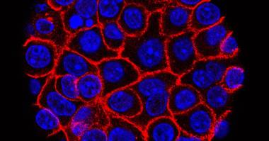 Innovative Pancreatic Cancer Drug Doubles Patient Survival in Trials